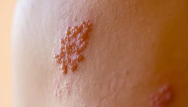Mụn rộp sinh dục (Herpes): Nguyên nhân, triệu chứng và cách điều trị